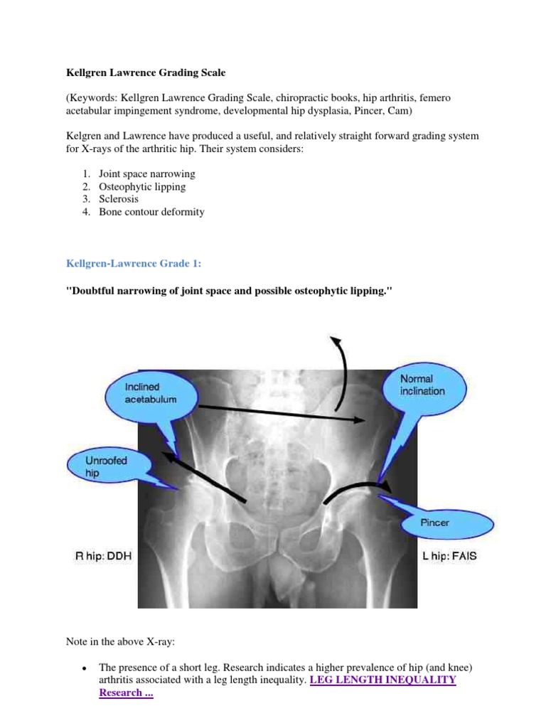 Kellgren Lawrence Grading Scale | PDF | Osteoarthritis | Knee