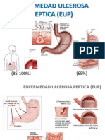 Enfermedad Ulcerosa Peptica (Eup)