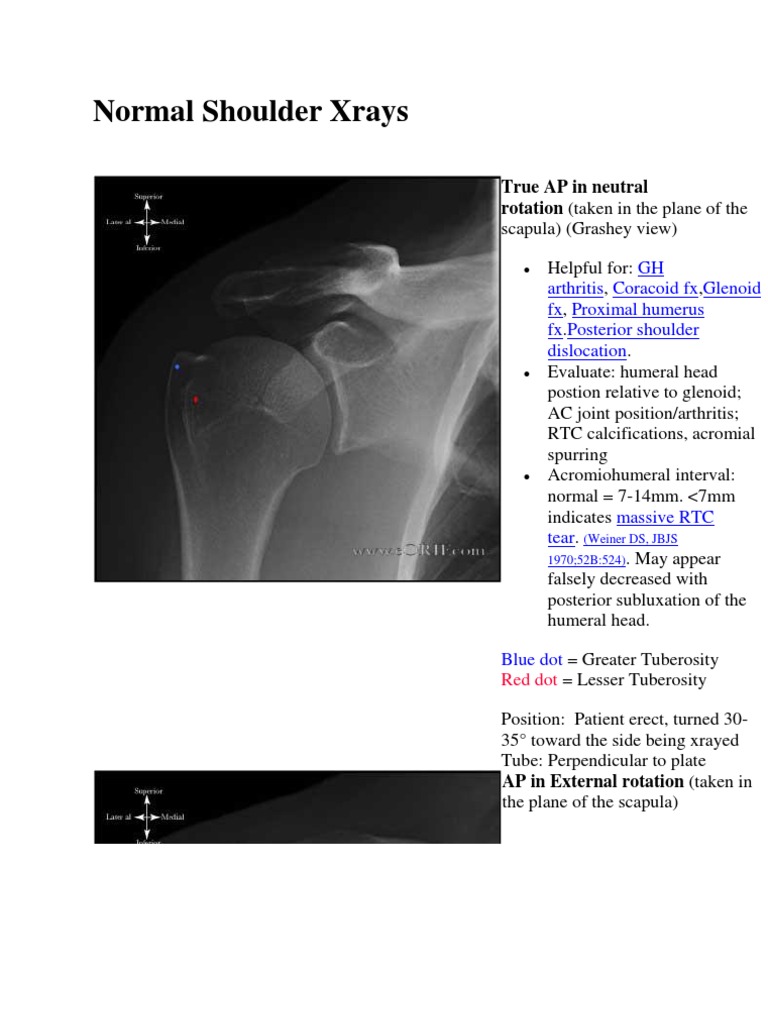 Normal Shoulder Xrays: True AP in Neutral Rotation (Taken in The Plane ...