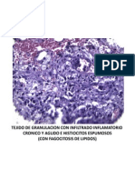 Pseudoquist Pancreat