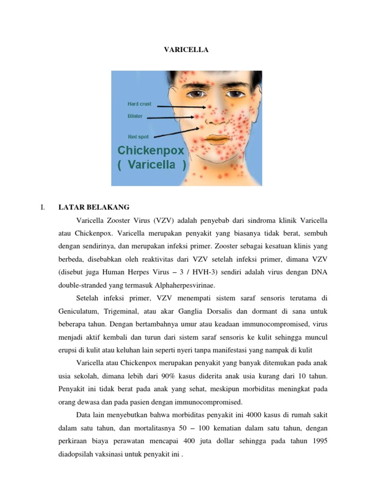 Varicella | PDF | Pengembangan Diri | Kesehatan Holistik