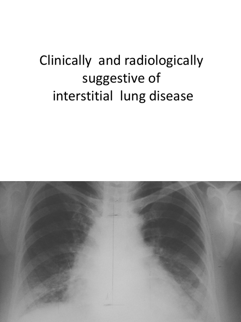 Clinically and Radiologically Suggestive of Interstitial Lung Disease | PDF