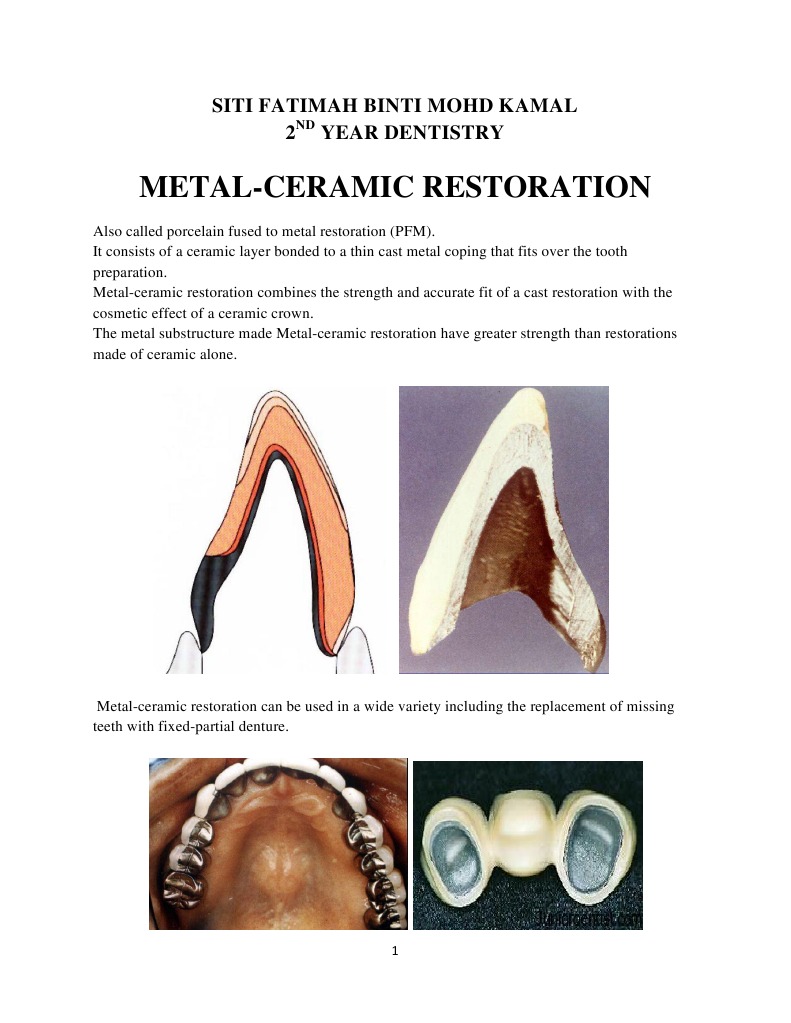 Metal Ceramic Restoration Mouth Dentistry Prueba gratuita de 30
