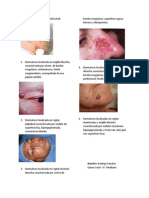 Carcinoma Basocelular