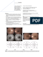 Bilateral Macular Choroiditis Following Chikungunya