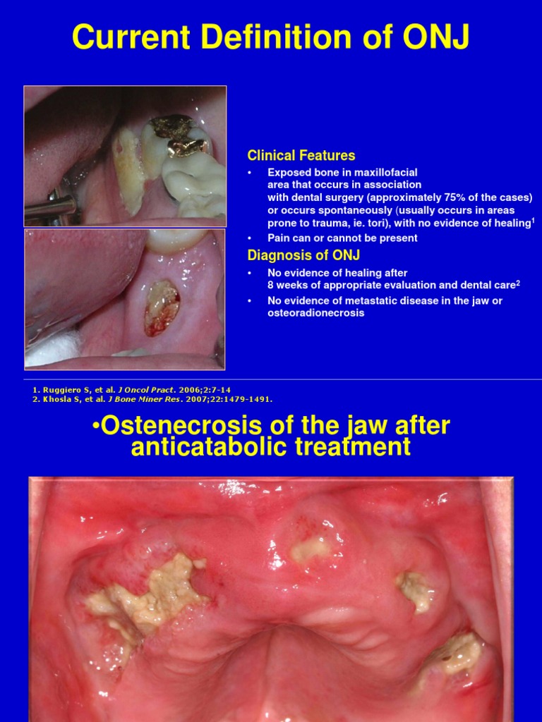 Osteonecrosis Jaw PDF Clinical Medicine Medicine