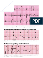 ECG Patterns of Acute and Chronic Myocardial Infarctions