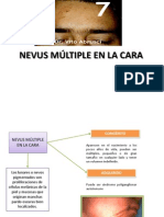 NEVUS MÚLTIPLE EN LA CARA