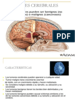 13-tumores-cerebrales