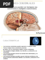 13-tumores-cerebrales