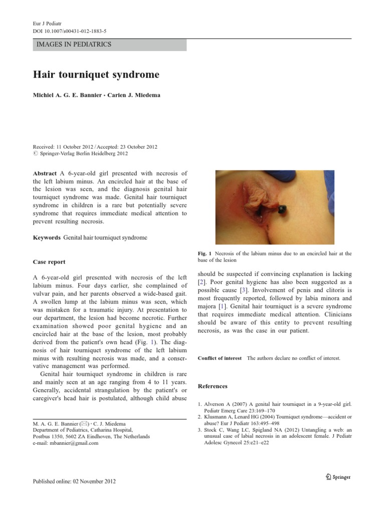 Hair Tourniquet Syndrome PDF Labia Syndrome