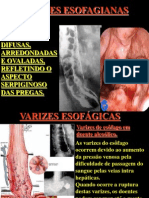 Varizes esofágicas e tumores benignos e malignos do esôfago