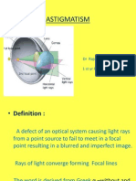 Astigmatism