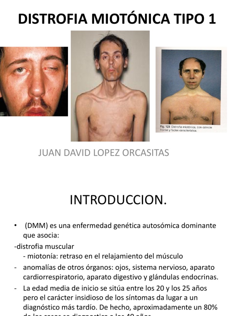 Distrofia Miotónica Tipo 1: Aspectos Clave | PDF | Músculo | Medicina