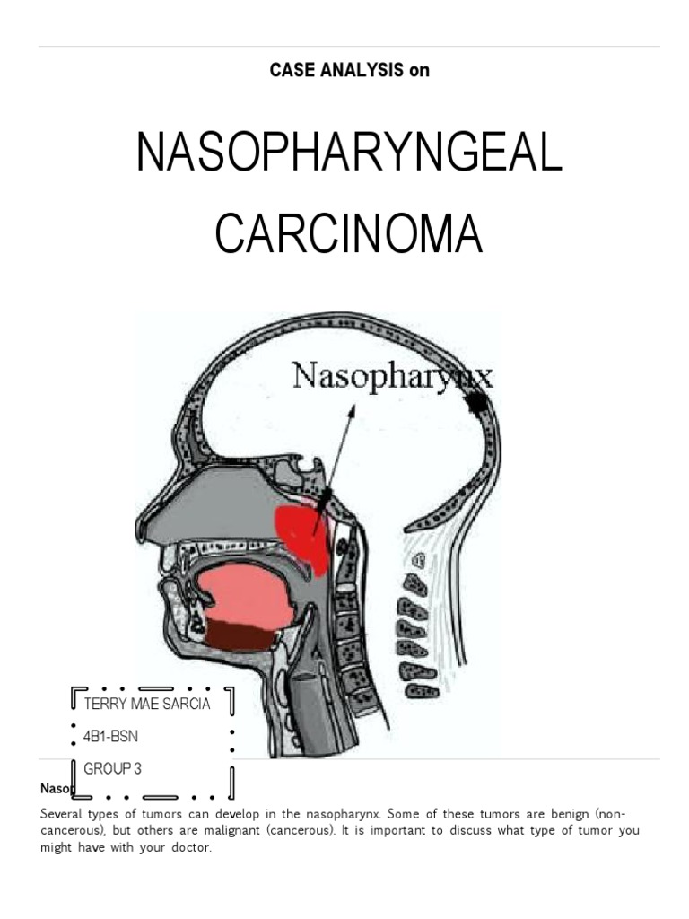 Nasopharyngeal Carcinoma Overview | PDF | Radiation Therapy | Metastasis