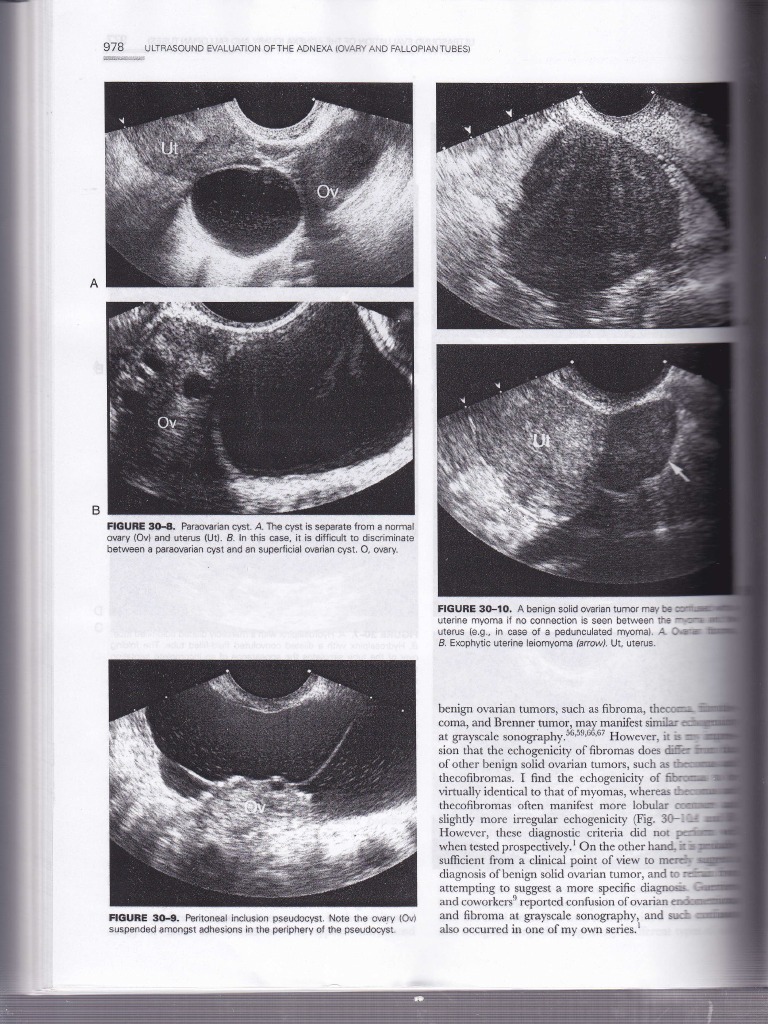 Ultrasound Evaluation of Ovarian Cysts | PDF | Wellness | Science ...
