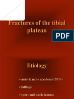 Fractures of The Tibial Plateau