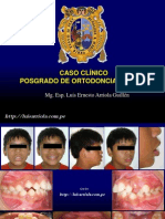 Caso Clínico 8 Técnica Bioprogresiva, Microimplantes y Finalización Con Meaw