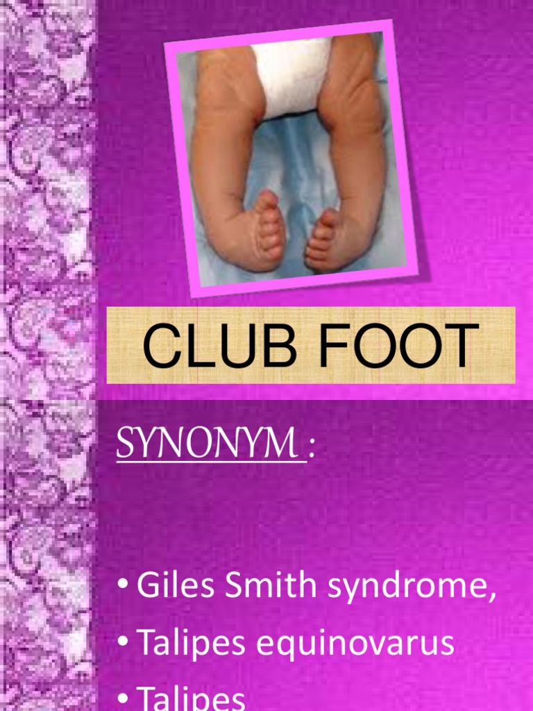 Club Foot PDF Foot Hip