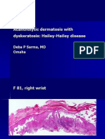 Acantholytic Dermatosis With Dyskeratosis