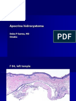 Apocrine Hidrocystoma. F 84, Left Temple. Revised Sept 2010 DS