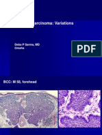 Basal Cell Carcinoma Variations