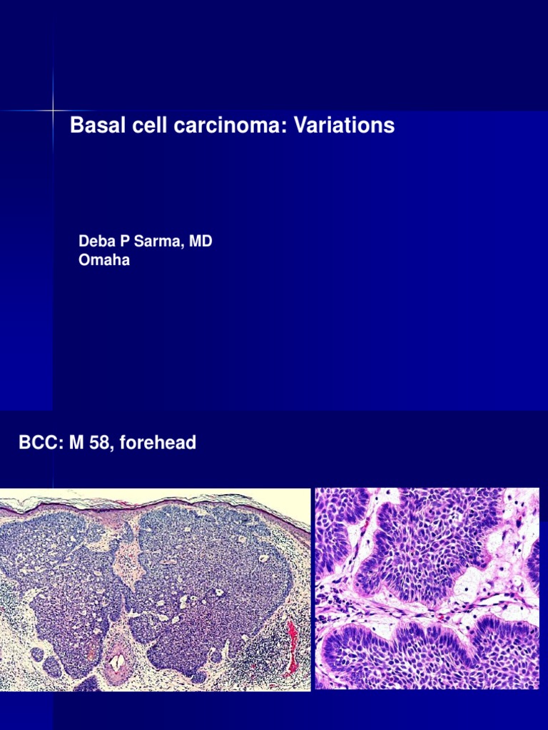 Basal Cell Carcinoma Variations | PDF