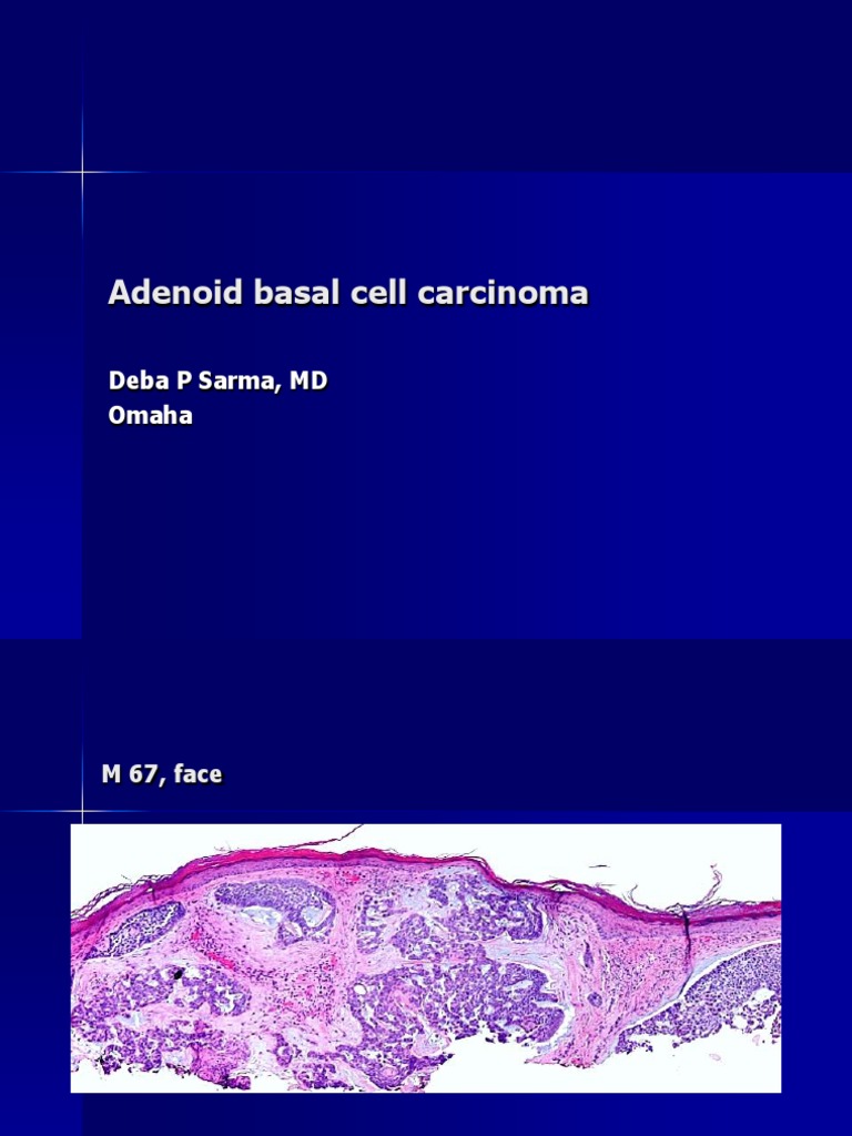 Basal Cell Carcinoma, Adenoid Type, M 67, Face PDF
