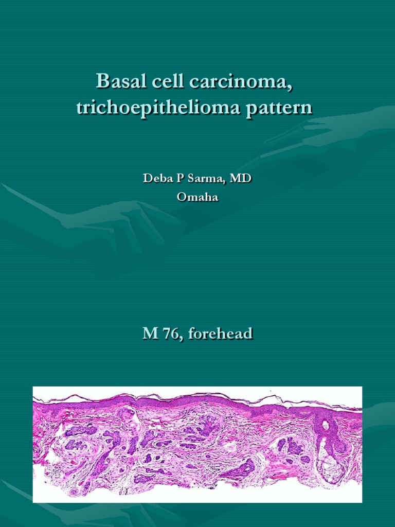 Basal Cell Carcinoma, Trichoepithelioma Pattern | PDF
