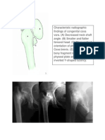 Characteristic Radiographic Findings of Congenital Coxa Vara