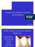 LCNC causas y características