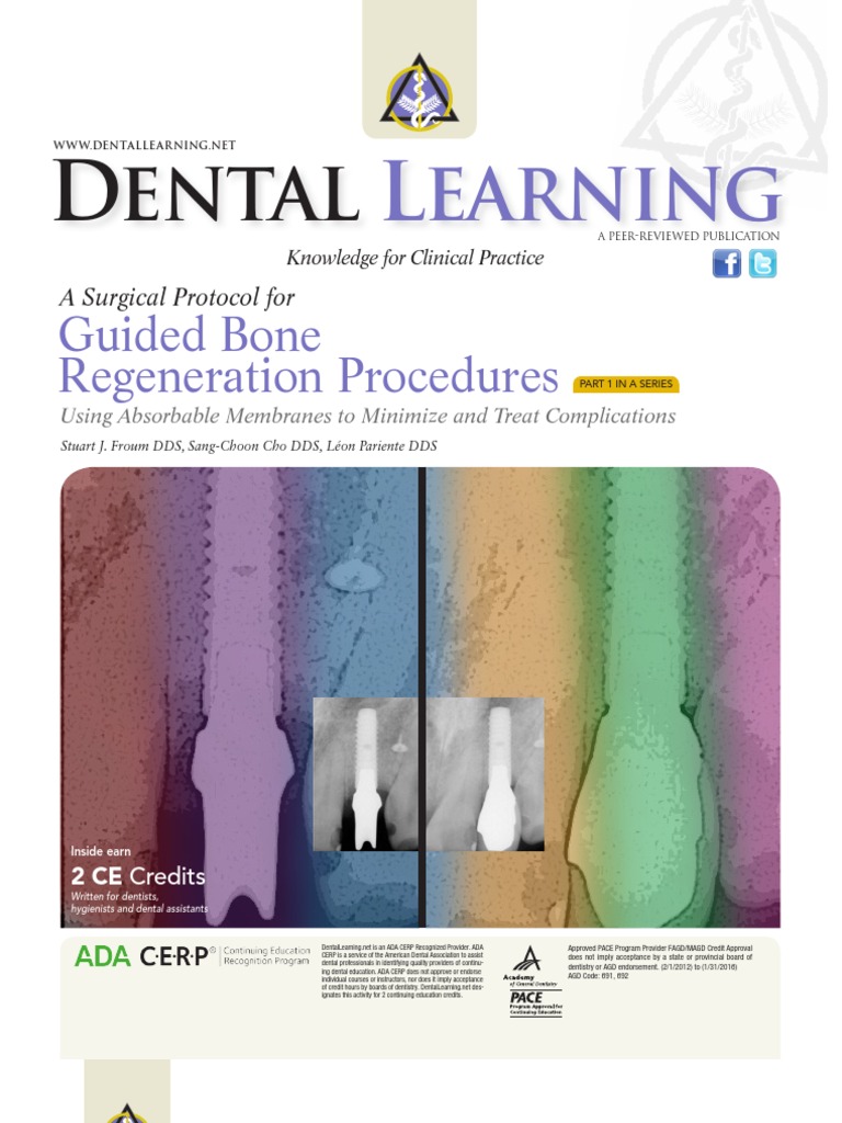 Guided Bone Regeneration Procedure Dental Implant Surgical Suture
