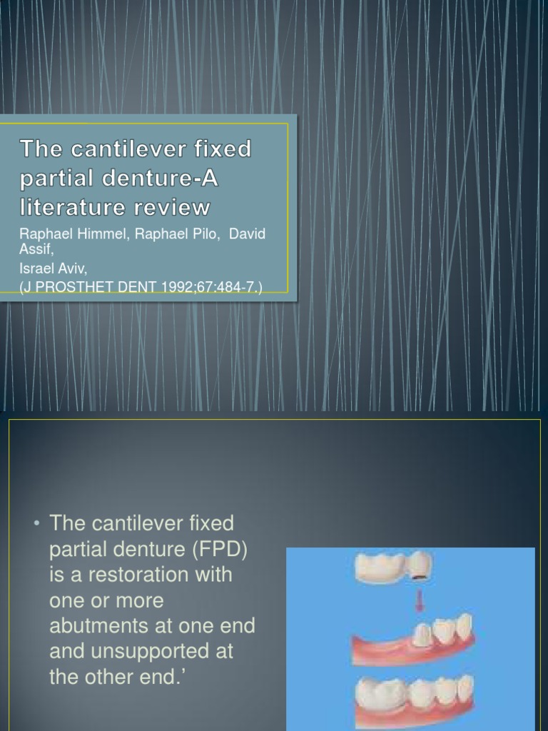 The Cantilever Fixed Partial DentureA Literature Review PDF Human