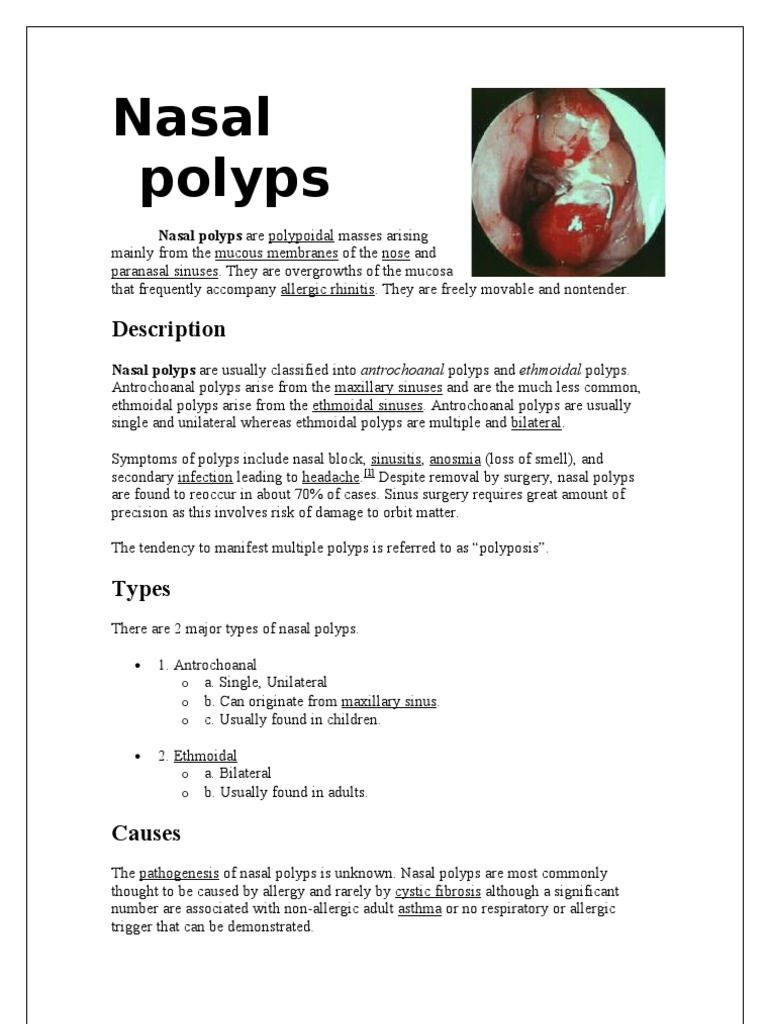 Nasal Polyps | PDF | Surgery | Medical Specialties, image size:768x1024