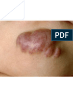 Hemangioma