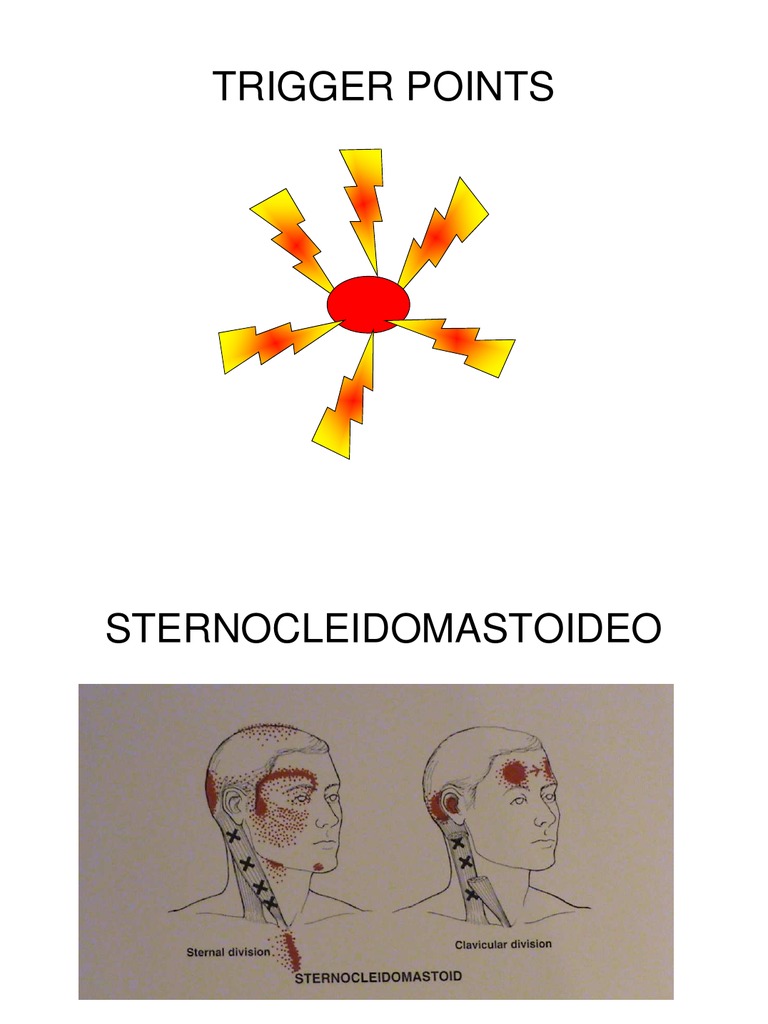 Trigger Points | PDF
