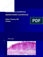 Acantholytic Acanthoma (Epidermolytic Acanthoma), M 65, Neck