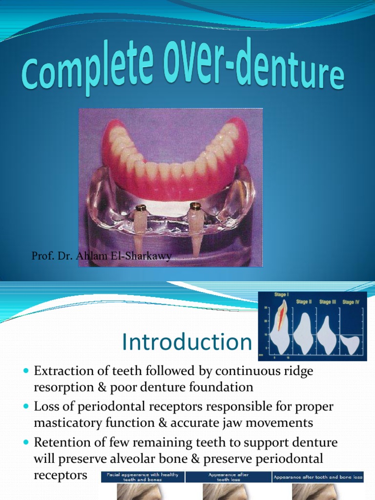 Types and Indications of Overdentures | PDF