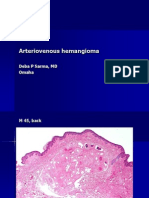 Arteriovenous Hemangioma, M 45, Back