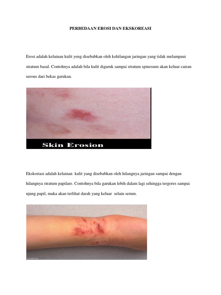 Perbedaan Erosi dan Ekskoriasi Kulit | PDF | Sejarah | Fiksi Umum