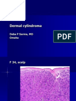 Dermal Cylindroma, F 34 Scalp