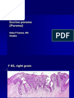 Eccrine Poroma. F 85, Right Groin