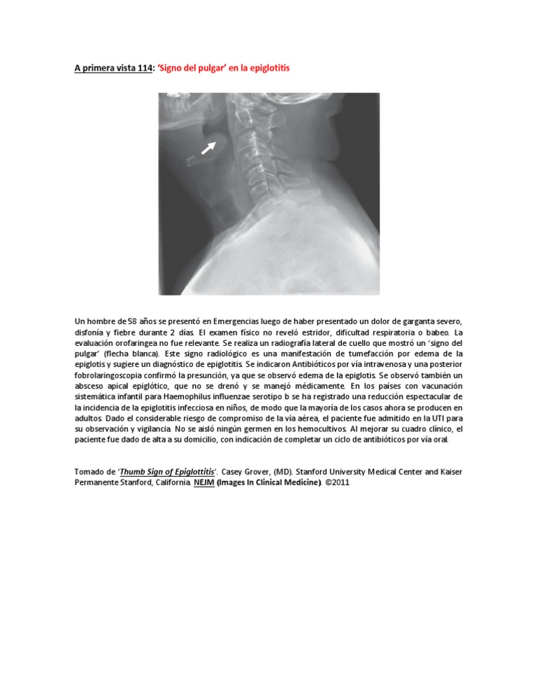 A Primera Vista 114 (Signo Del Pulgar en La Epiglotitis) | PDF ...