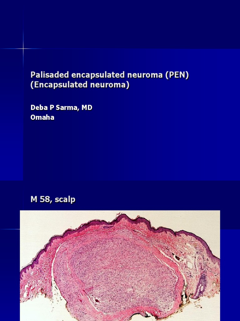 Palisaded Encapsulated Neuroma M 58 Scalp Pdf