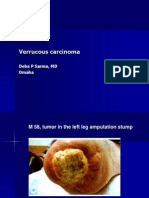 Verrucous Carcinoma., M 58, Left Leg Amputation Stump