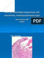 Well Differentiated Squamous Cell Carcinoma, Keratoacanthoma Type
