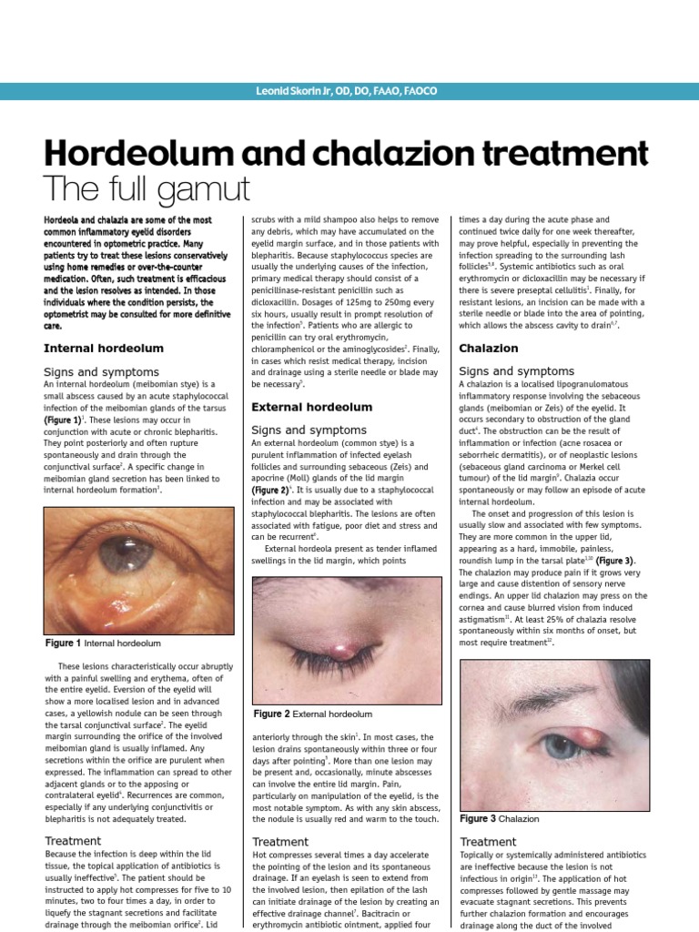 Hordeolum and Chalazion Treatment Health Sciences Medical