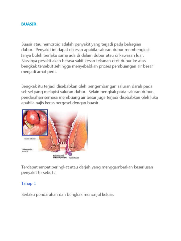 Buasir Pdf