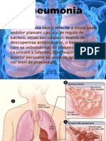 Pneumonia