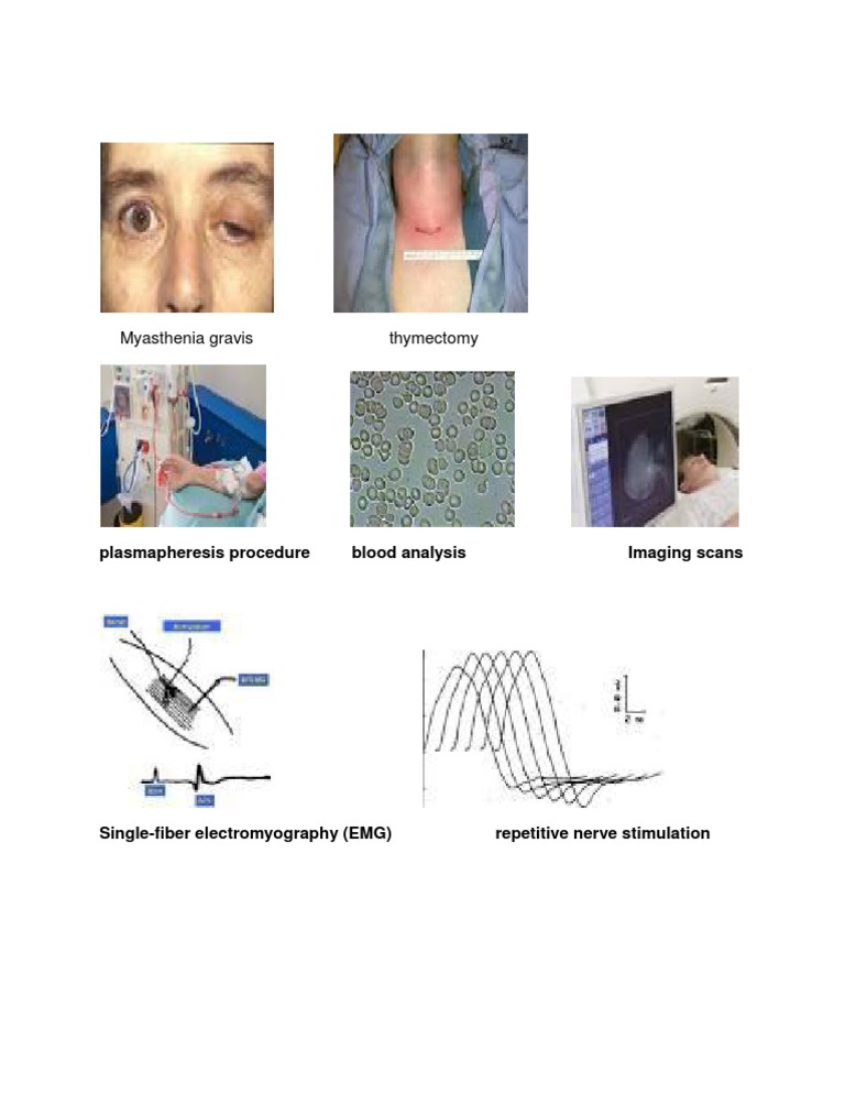 Myasthenia Gravis Thymectomy PDF